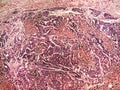 Liver cancer of a human