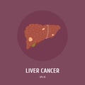 Liver cancer. Internal organs of man. Surgery. Vector Flat Illustration