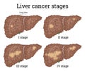 Liver cancer stages Royalty Free Stock Photo