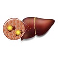 Liver Cells Attacked by Toxins