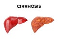 Liver cirrhosis is a chronic inflammation of the liver, a fibrous tissue replaces normal liver tissue, blocking blood flow