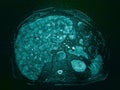 liver metastasis MRI