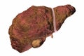 Liver cirrhosis illustration