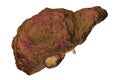 Liver cirrhosis illustration