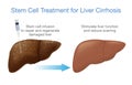 Liver cirrhosis treatment with stem cells.