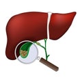 liver. Close-up of Gallbladder. magnifying glass examines gallstones