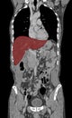 Liver on computed tomography