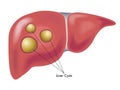 Liver cysts