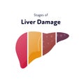 Liver damage infographic. Vector flat illustration. Anatomical human organ. Stages of cirrhosis disease from healthy to fatty and