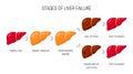 Liver damage vector concept