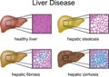 Liver Disease Royalty Free Stock Photo