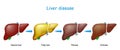 Liver disease. From healthy internal organ to Fatty liver, fibrosis, and Cirrhosis Royalty Free Stock Photo