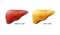 Comparison of healthy liver and fatty live.