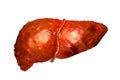 Liver disease