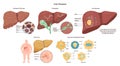 Liver diseases set. Hepatic system organ pathology. Liver damage