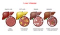 Liver diseases. Stages of liver damage Royalty Free Stock Photo