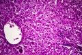 Liver edema, light micrograph Royalty Free Stock Photo