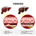 Liver fibrosis