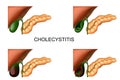 Liver, gall bladder and pancreas. cholecystitis