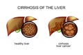 The liver healthy and the patient with cirrhosis