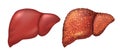 Liver of healthy person. Liver patients with hepatitis. Liver is sick person. Cirrhosis of liver. Repercussion alcoholism Royalty Free Stock Photo