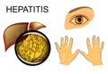 Liver, hepatitis and yellowing of eyes and hands