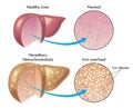 Liver with hereditary hemochromatosis