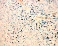 Liver. Kupffer cells loaded with iron. Perlâs reaction Royalty Free Stock Photo