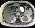 Liver pancreas mri pathology cholangiogram exam