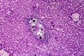 Liver schistosomiasis, light micrograph Royalty Free Stock Photo