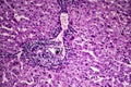 Liver schistosomiasis, light micrograph Royalty Free Stock Photo