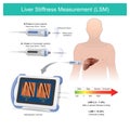 Liver Stiffness Measurement. Measuring tissue liver stiffness in patients by using the reflection sound waves for diagnose of