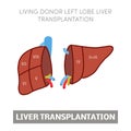 Liver transplantation concept