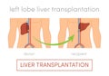 Liver transplantation concept