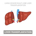 Liver transplantation concept