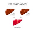 Liver transplantation vector concept