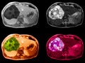 liver cancer MRI