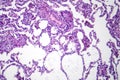 Lobar pneumonia in dissolved dissipate period, light micrograph