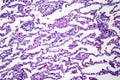 Lobar pneumonia in dissolved dissipate period, light micrograph