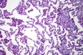 Lobar pneumonia in dissolved dissipate period, light micrograph