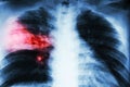 Lobar pneumonia . film chest x-ray show alveolar infiltration at right middle lobe due to tuberculosis infection . Royalty Free Stock Photo