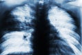 Lobar Pneumonia