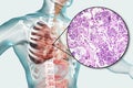 Lobar pneumonia, grey hepatic phase Royalty Free Stock Photo