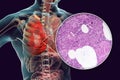 Lobar pneumonia, hemorrhagic edema period