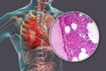 Lobar pneumonia, hemorrhagic edema period