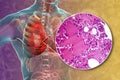 Lobar pneumonia, hemorrhagic edema period