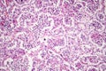 Lobar pneumonia, red hepatic phase