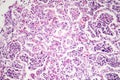 Lobar pneumonia, red hepatic phase