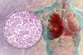 Lobar pneumonia, red hepatic phase