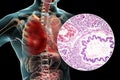 Lobar pneumonia, red hepatic phase